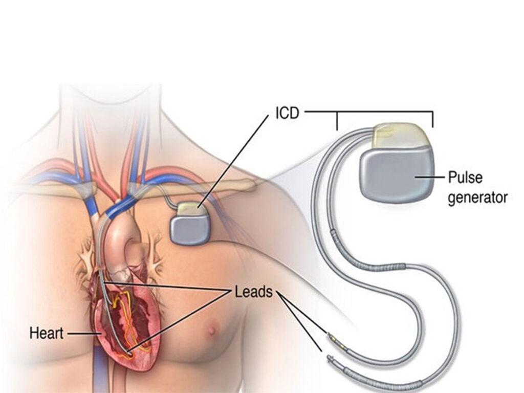 Pacemaker-&-ICD-2