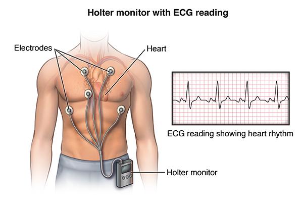 Natural electrical impulses coordinate contractions of the different parts of the heart. This keeps blood flowing the way it should. An ECG records these impulses to show how fast the heart is beating, the rhythm of the heart beats (steady or irregular), and the strength and timing of the electrical impulses. Changes in an ECG can be a sign of many heart-related conditions.